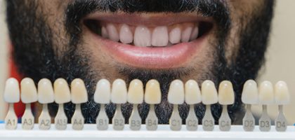 blanqueamiento dental madrid
