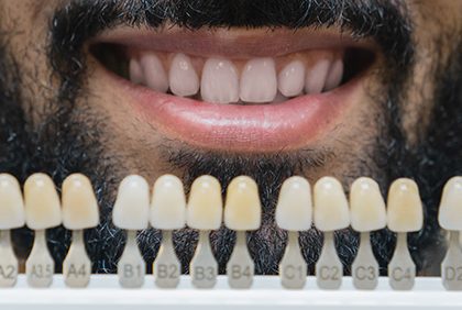 blanqueamiento dental madrid