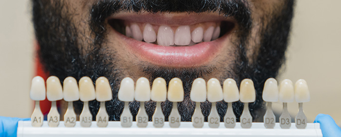 blanqueamiento dental madrid