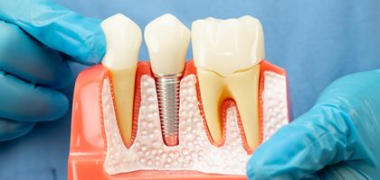¿Qué es un implante dental y cómo es el proceso? Guía clara para pacientes en Madrid (Aluche)