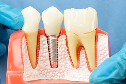 ¿Qué es un implante dental y cómo es el proceso? Guía clara para pacientes en Madrid (Aluche)
