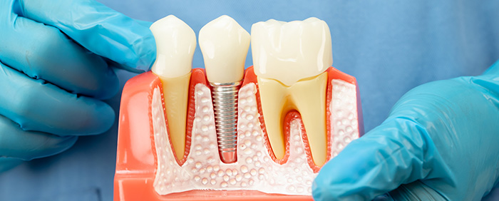 ¿Qué es un implante dental y cómo es el proceso? Guía clara para pacientes en Madrid (Aluche)