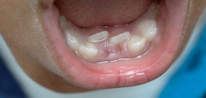 niños dientes leche tiburón dos filas