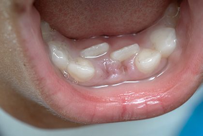 niños dientes leche tiburón dos filas