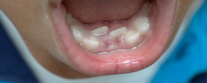 niños dientes leche tiburón dos filas