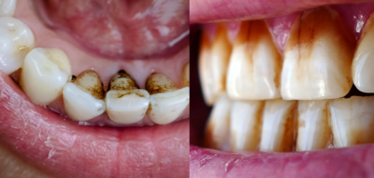 Manchas en los dientes