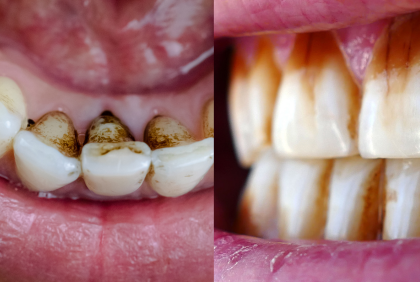 Manchas en los dientes