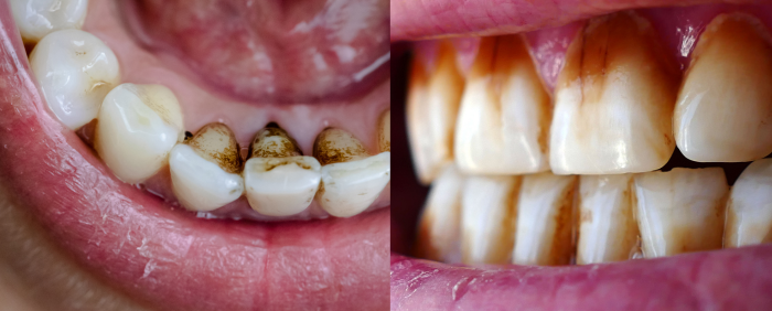 Manchas en los dientes